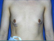 MtF Surgery | Cleveland