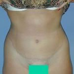 Abdominoplasty | Cleveland