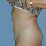 Abdominoplasty | Cleveland