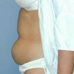 Abdominoplasty | Cleveland