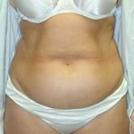 Abdominoplasty | Cleveland