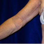 Brachioplasty Cleveland