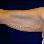 Brachioplasty | Cleveland