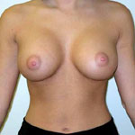 Breast Augmentation | Cleveland