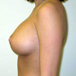 Breast Augmentation | Cleveland