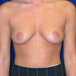 Breast Augmentation | Cleveland