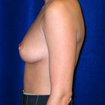 Breast Augmentation | Cleveland