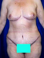 Weight Loss | Cleveland