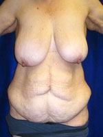 Weight Loss | Cleveland