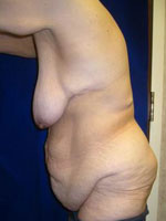 Weight Loss | Cleveland