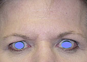 brow lift before
