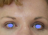 browlift-after-crop