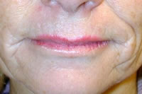 Laser Resurfacing| Cleveland