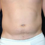 Liposuction| Cleveland