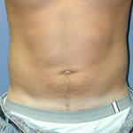 Liposuction| Cleveland