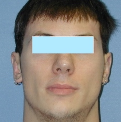 otoplasty after