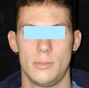 otoplasty before