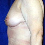 Breast Lift | Cleveland