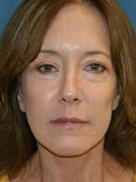 After Facelift