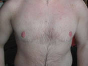 MtF Surgery | Cleveland