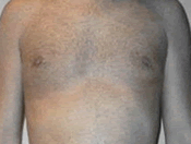 MtF Surgery | Cleveland