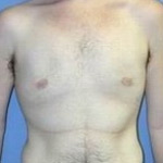 Breast Lift | Cleveland