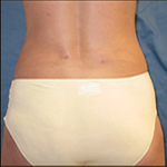 Liposuction| Cleveland