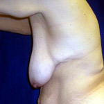 Breast Lift | Cleveland