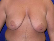MtF Surgery | Cleveland