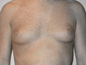 MtF Surgery | Cleveland
