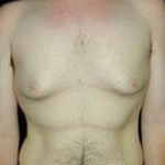 Breast Lift | Cleveland