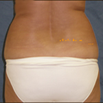 Liposuction| Cleveland