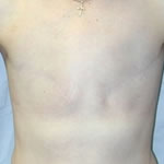 Breast Reconstruction | Cleveland
