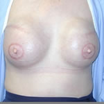 Breast Reconstruction | Cleveland