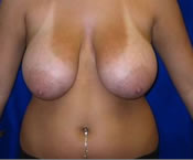 Breast Reduction| Cleveland