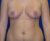 Breast Reduction| Cleveland