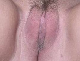 Excess Labia Minora