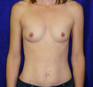 breast augment before and after