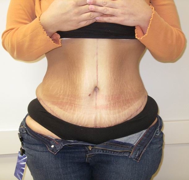 Weight loss during tb medication photo 10