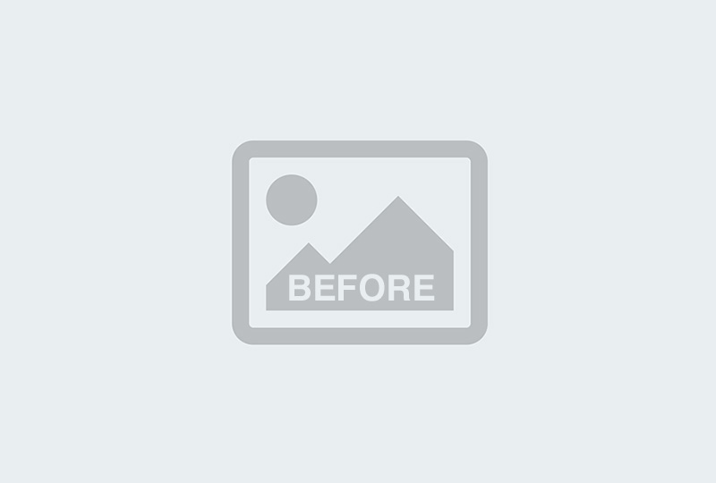 Before Image: Labia Majora Fat Grafting, Labiaplasty and Clitoral Hood Reduction - front