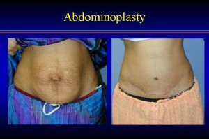 Extreme abdominal laxity and belly button hernia repaired by abdominoplasty