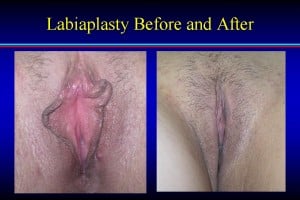 Labiaplasty Before and AFter 300x200