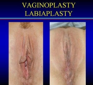 Labiaplasty vaginoplasty1 300x273