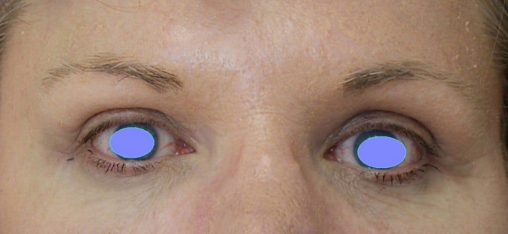 After Image of Brow Lift Cleveland