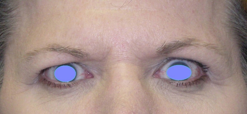 Before Image of Brow Lift Cleveland