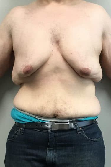 Male Breast Reduction after Weight Loss 3307