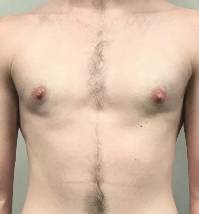 FtM top Surgery Before and After Results - Daniel A. Medalie, M.D ...