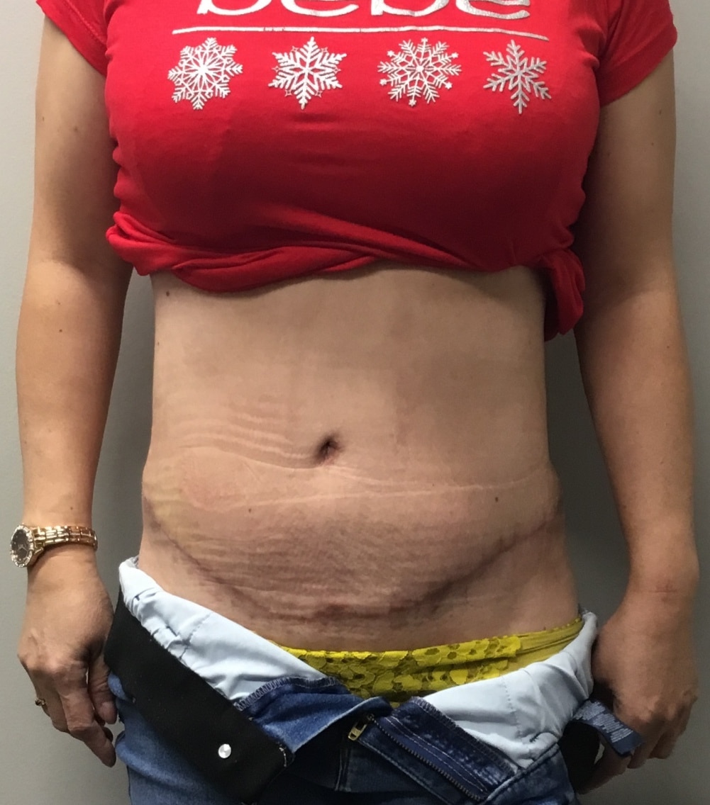 Amazing tummy tuck before and after surgery photos 4375