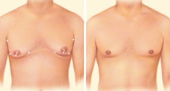 05 liposuction combo 01 02
