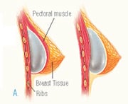 08 inserting (1)